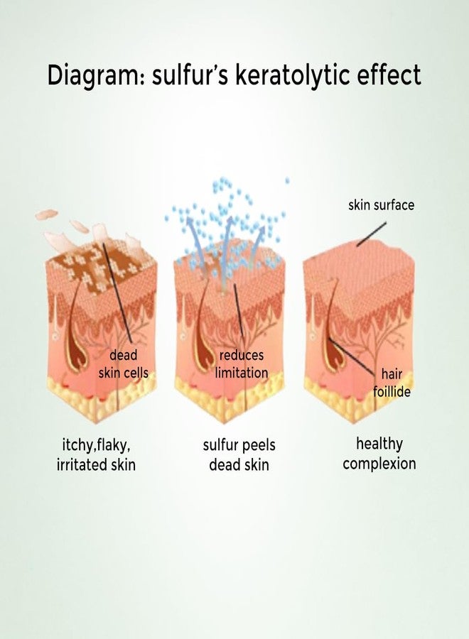 Moody Acnexpert Spot Corrector Pen with Salicylic Acid 0.3% & Green Tea | Acne Removal | Salicylic Acid Gel | For Active Acne & Pimples | Dries Out Active Acne For Women & Men | Safe on All Skin Type 10ml - Image 5