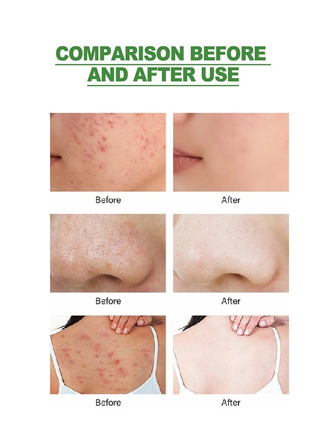 EELHOE Acne Removal Treatment Cream, Oil Control Acne Removal Acne Pimple Repair Cream, Acne Spot Treatment for Face & Acne Dots, Natural Cystic Acne Treatment Suitable for Oily And Acne Prone Skin 20g - Image 5