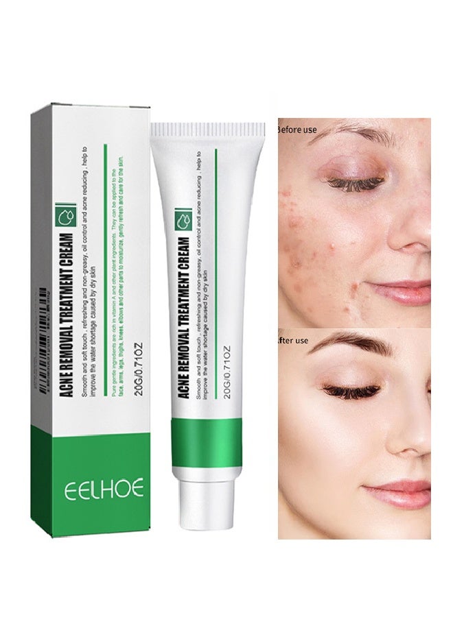 EELHOE Acne Removal Treatment Cream, Oil Control Acne Removal Acne Pimple Repair Cream, Acne Spot Treatment for Face & Acne Dots, Natural Cystic Acne Treatment Suitable for Oily And Acne Prone Skin 20g - Image 1