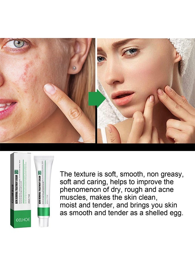 EELHOE Acne Removal Treatment Cream, Oil Control Acne Removal Acne Pimple Repair Cream, Acne Spot Treatment for Face & Acne Dots, Natural Cystic Acne Treatment Suitable for Oily And Acne Prone Skin 20g - Image 3