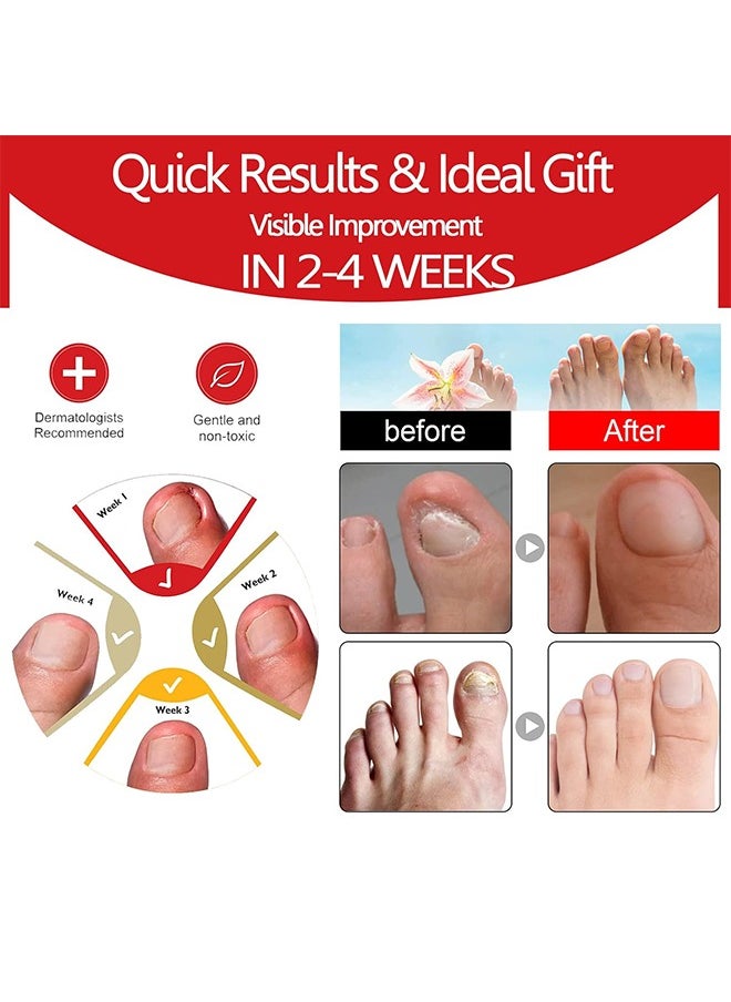 SOUTH MOON - Ingrown Toenail Drops Repair Essence, Nail Care Essential Oil Cleans And Removes Gray Nails, Toe Nail Repair Treatment Extra Strength For Thick Nails Cracked Damaged Discolored Yellow Nails - Image 1
