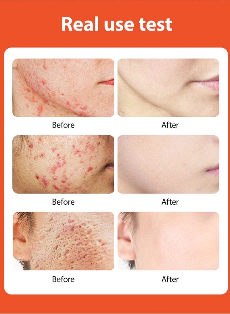 MOOYAM Acne Treatment for Face for Hormonal Cystic Stubborn Acne Cream for Sensitive Skin Teens Adults 30g - Image 2