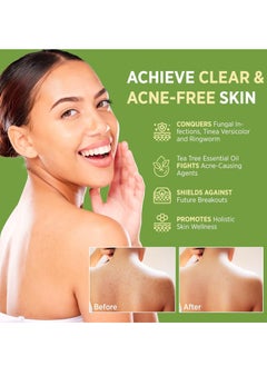 Roycederm Roycederm Antifungal Antibacterial Tea Tree Soap: Antifungal Antibacterial Treatment for Face & Body Acne, Athlete's Foot, Tinea, Folliculitis Ringworm Jock Itch (Pack of 1)  - Image 4
