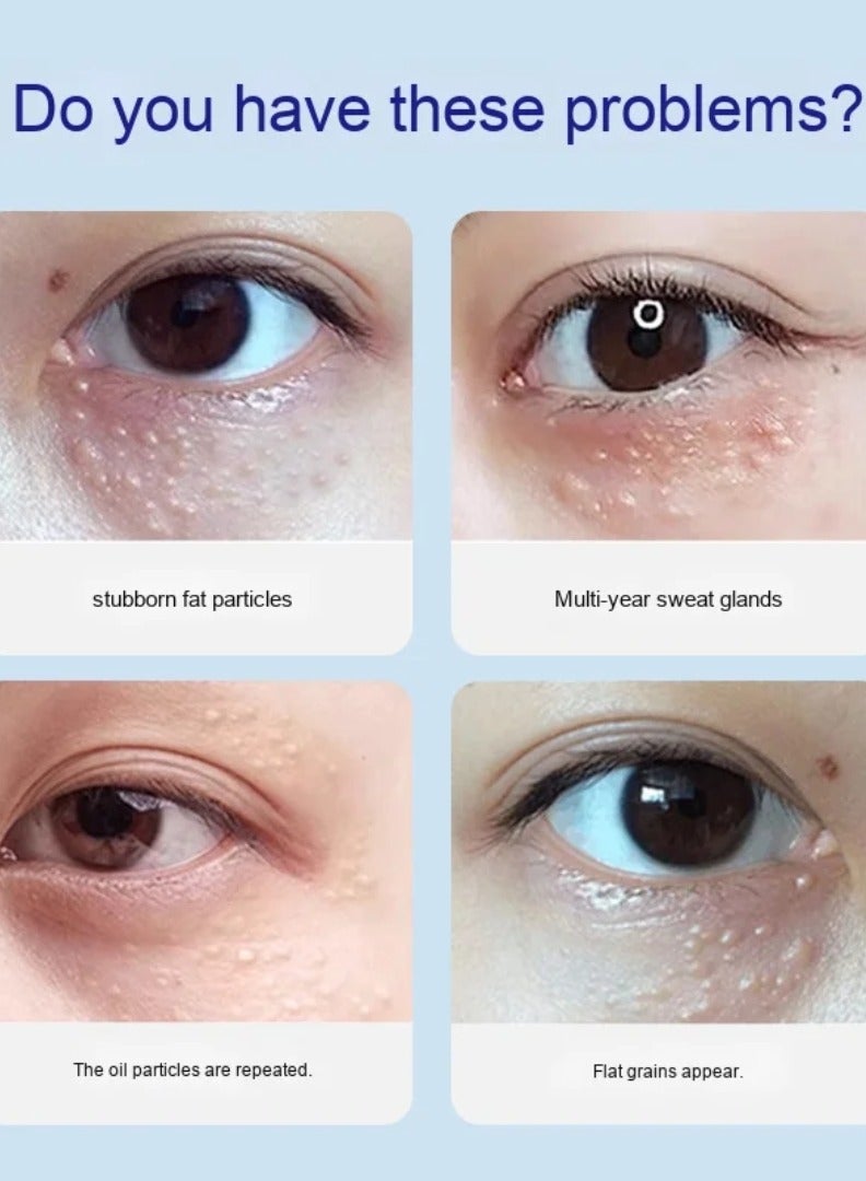 DERMFREE Milia Remover Treatment Fat Granule Clearing Skin Essence Smooth Skin Gentle and Moisturizing Fat Grain Removal Liquid Milia Spot Treatment Helps Dissolve and Reduce Milia Face Serum 30ml - Image 4