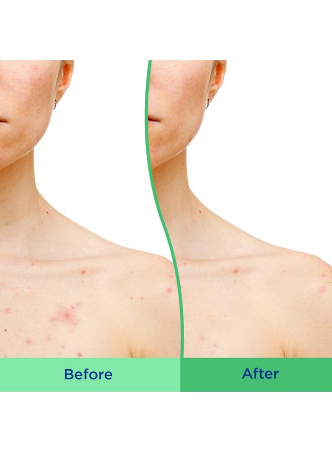 differin Differin Body Scrub with Salicylic Acid Acne Clearing Improves Tone and Texture Prone Skin on Back Shoulders and Chest, 8 Oz (Packaging May Vary) - Image 5
