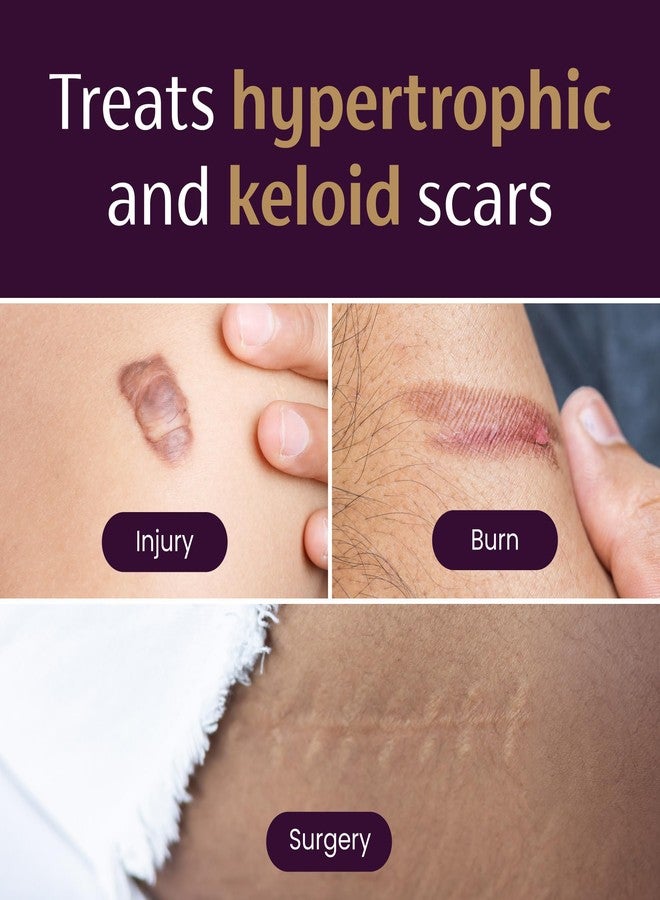 Mederma Medical Grade Silicone Scar Sheets - Improves Appearance of Old & New Scars from Injury, Burn & Surgery, Breathable & Flexible, 4 Count - Image 5