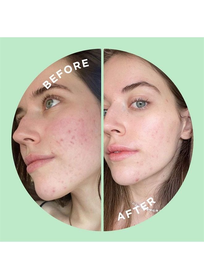 ZITSTICKA قناع ورقي مقشر ومرطب للوجه لتلطيف البشرة المعرضة لحب الشباب (1 عبوة) - Image 5