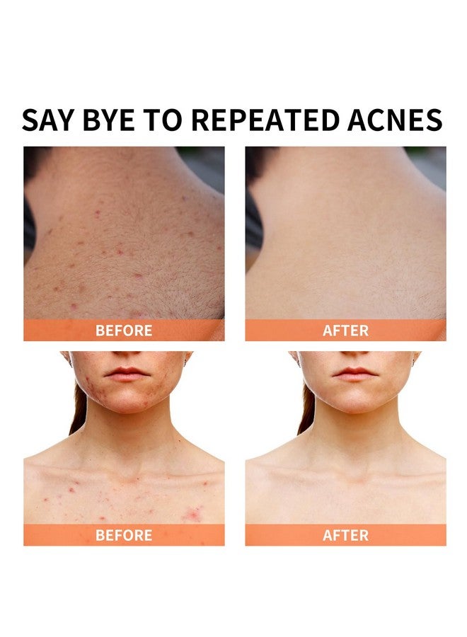 YAFUSIPE Acne Treatment for Face, Acne Cream Back Acne Treatment Cream for Teens & Adults Anti-acne Pimple Cream Butt Acne Clearing Cream, Acne Spot Treatment - Image 5