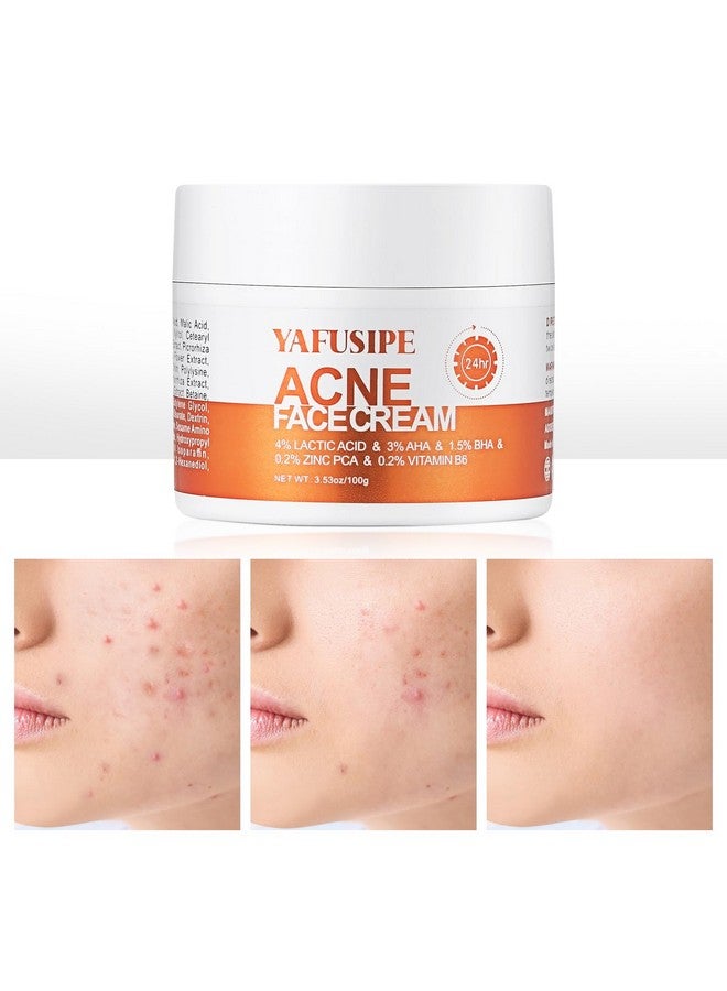 YAFUSIPE Acne Treatment for Face, Acne Cream Back Acne Treatment Cream for Teens & Adults Anti-acne Pimple Cream Butt Acne Clearing Cream, Acne Spot Treatment - Image 1