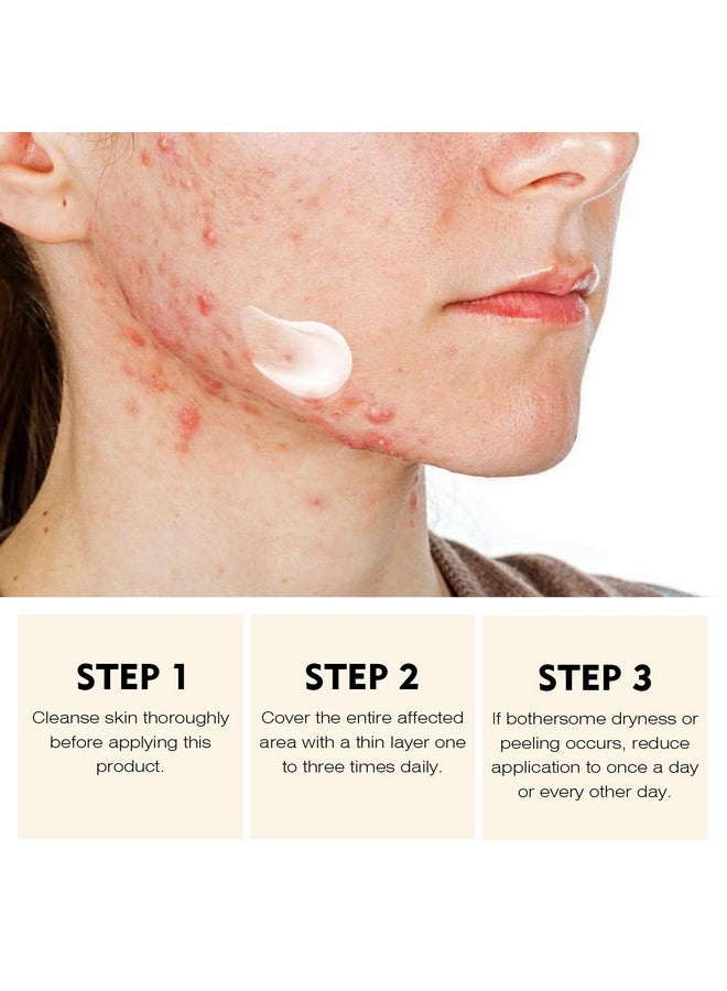 YAFUSIPE Acne Treatment for Face, Acne Cream Back Acne Treatment Cream for Teens & Adults Anti-acne Pimple Cream Butt Acne Clearing Cream, Acne Spot Treatment - Image 4