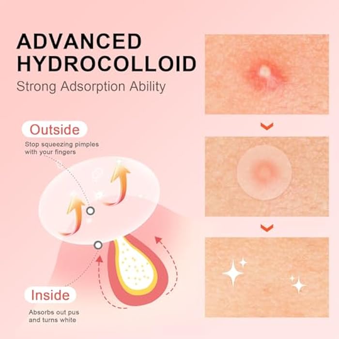 AVJONE Pimple Patches for Face(144 Patches), Hydrocolloid Acne Patches with Tea Tree Oil, pimple stickers for Breakouts, Absorbs Zit, Invisible Spot Cover and Blemish - Image 2