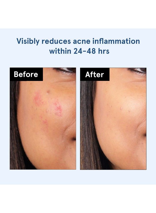 Bodywise Ise Acne Pimple Patch For Women & Men (24 Dots ; 3 Sizes) ; Absorbs & Flattens Acne Overnight ; Waterproof ; Reduces Excess Oil Shrinks Pimples & Clears Pores ; For All Skin Type - Image 5