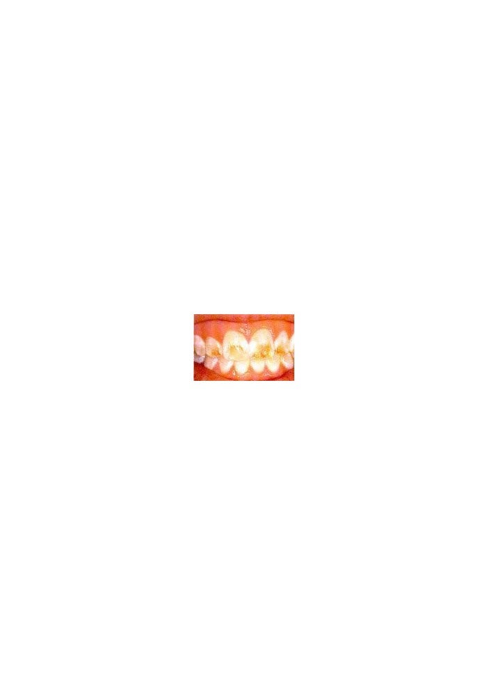 Archtek D.I.Y 10 Thermo-molding 'BOIL and BITE' Mouth Trays for Teeth Whitening - Image 2
