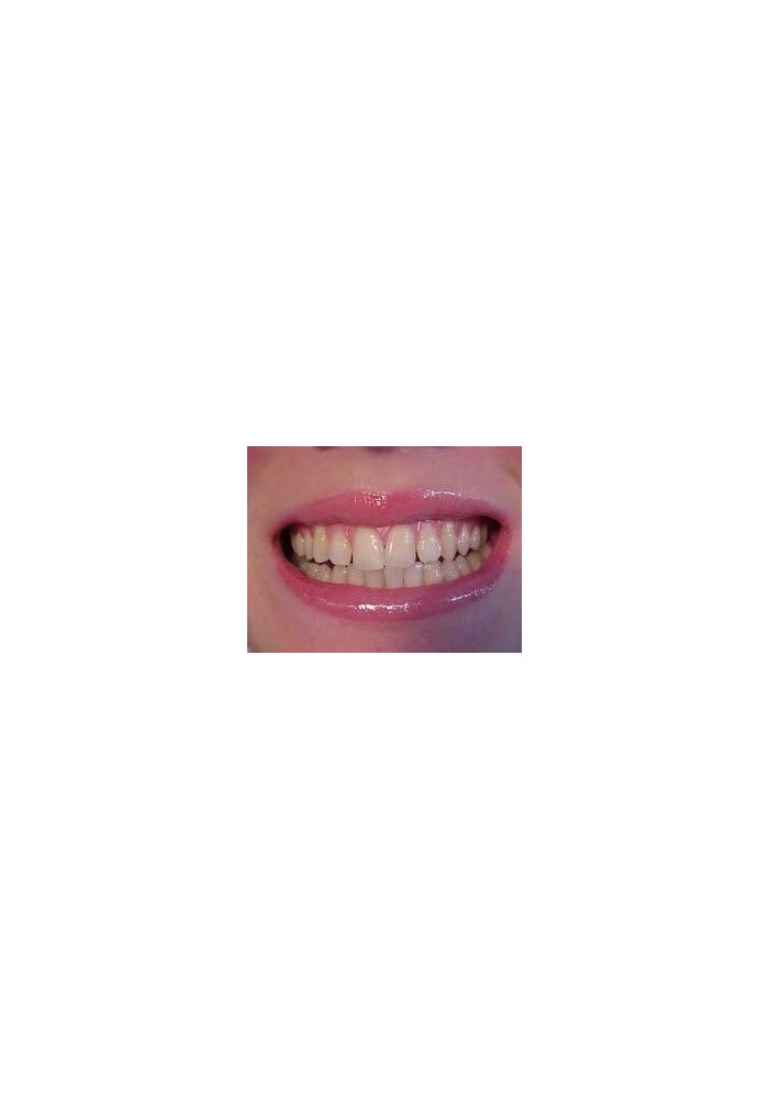 Archtek D.I.Y 10 Thermo-molding 'BOIL and BITE' Mouth Trays for Teeth Whitening - Image 4