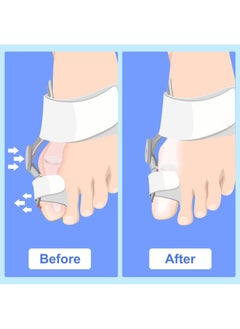 2 Pack Bunion Corrector Set - Toe Splint for Bunion Relief and Big Toe Straightening - Day and Night Support for Men and Women - pzsku/Z947AB0D44911531096B4Z/45/_/1713522237/56bd76f8-7eae-4129-910b-37dd2fb0dc50