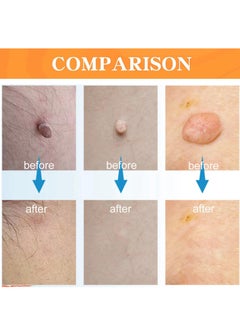 Excefore Warts & Mole Remover Cream,Natural Skin Tag Remover,Skin Tag Remover for Face & Hands & Body,Natural Formula,Skin Tag Remover Liquid,Tags and Mole Remover,Fast-Acting & Effective Skin Tag Remover  - Image 2