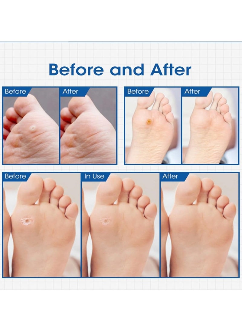 MQFORU - 24 Pcs Corn Remover Pads Corn Plasters with Hole for Feet Hand Toe Corn Removal Ideal for Relief Corn Pain and Foot Care Wart Remover Foot Corn Remover Patch Corn Removal Pads - Image 1