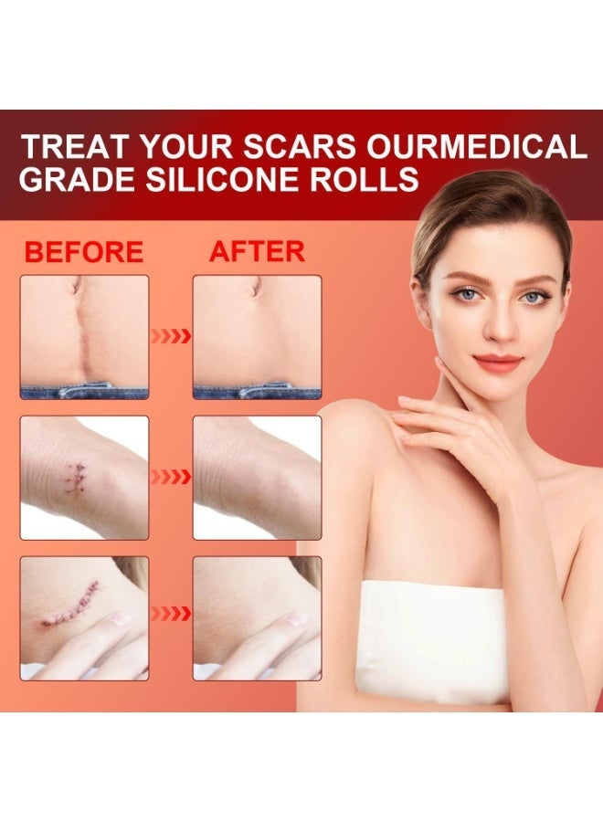 ningnatural Silicone Scar Sheets 1.5ms Medical Silicone Scar Tape Roll Easy Tear Soft Silicone Tape for Scars Removal Reusable Painless Silicone Sheets for Surgery Scars Section Burn Keloid - Image 4
