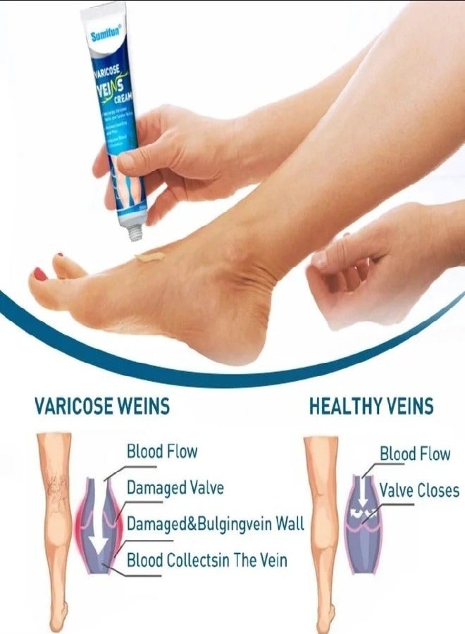 سوميفون كريم دوالي الساقين Sumifun كريم علاج دوالي الساقين Spider Varicose Veins Cream كريم مضاد لدوالي الساقين، مرهم مهدئ لدوالي الساقين 20 جرام (قطعة واحدة) - Image 3