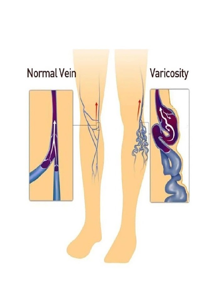 سوميفون كريم دوالي الساقين Sumifun كريم علاج دوالي الساقين Spider Varicose Veins Cream كريم مضاد لدوالي الساقين، مرهم مهدئ لدوالي الساقين 20 جرام (قطعة واحدة) - Image 4