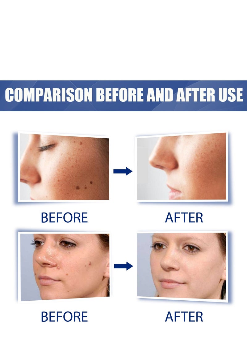 EELHOE Wart Removal Ointment Cream Skin Treatment With Natural Herbal Ingredients for The Treatment Of Common Warts Effective And Safe 20g - Image 4