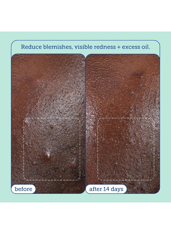 Skinfix - Acne+ 2% Bha + Azelaic Acid + Niacinamide + Aha Cleanser - Image 1