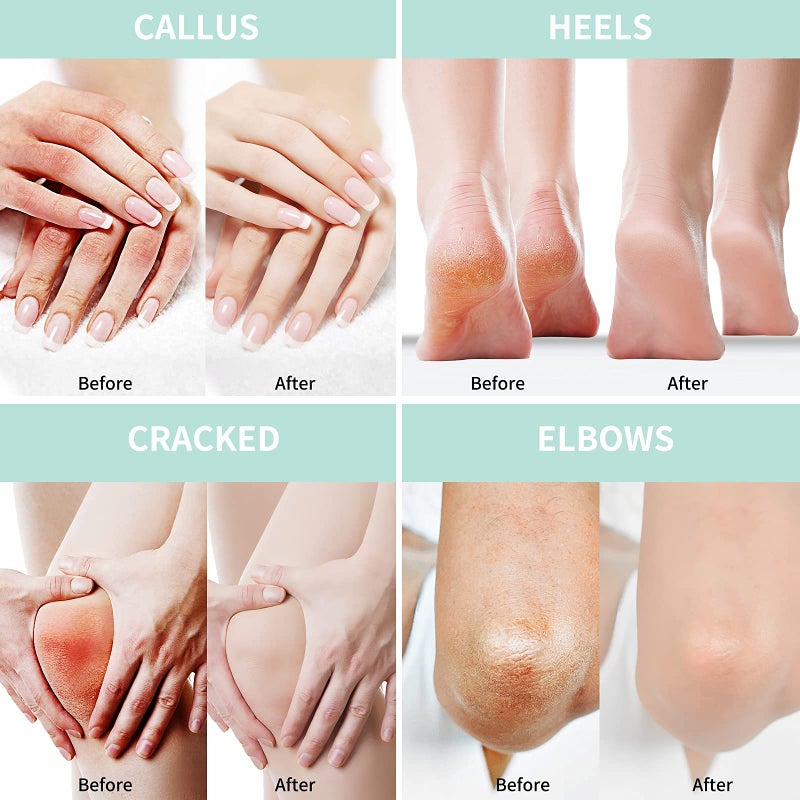 Grocerism 2 Packs Urea Cream 40% Plus 2% Salicylic Acid 5.30 oz || Foot Cream Maximum Strength with Hyaluronic Acid, Tea Tree, and Aloe Vera for Deep Moisturizes, Callus Remover and Soften - Image 4