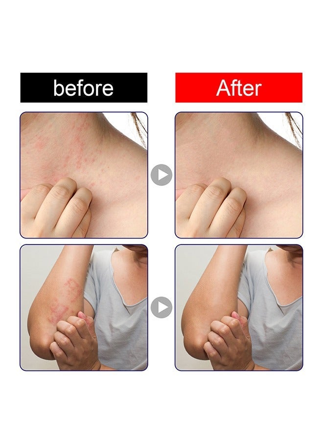 كريم مضاد للجراثيم ، حكة كريم العناية بالبشرة ، لدغة البعوض كريم مضاد للحكة