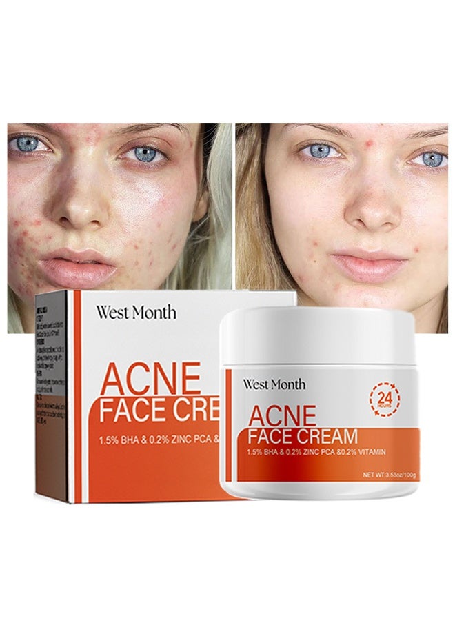 WEST MONTH Acne Face Cream, Acne Spot Treatment for Face & Acne Dots, Natural Cystic Acne Treatment, For All Skin Types, Premium Acne Scar Cream & Pimple Remover 100g - Image 1