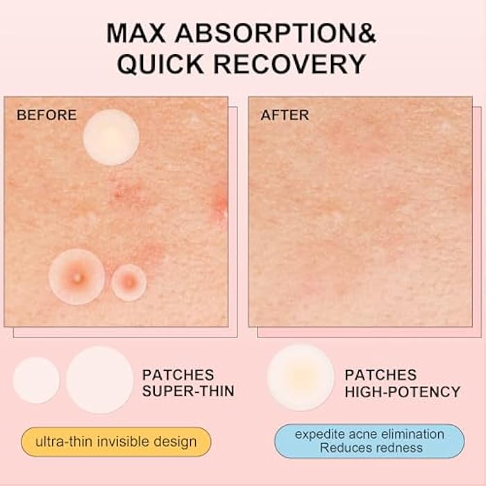 AVJONE Pimple Patches for Face(144 Patches), Hydrocolloid Acne Patches with Tea Tree Oil, pimple stickers for Breakouts, Absorbs Zit, Invisible Spot Cover and Blemish - Image 3