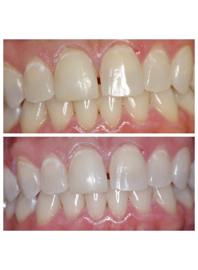 Ultra White Teeth Whitening Gel for Trays 16 Carbamide Peroxide 5 Syringes 140 Applications Sensitive Teeth Formula DentistDeveloped Made in USA Ultra White No Lights Required - Image 5