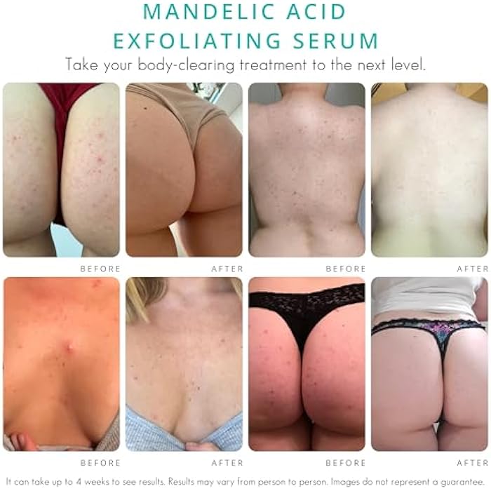 Almond Clear سيروم تنظيف الجسم [1 أونصة سائلة] سيروم حب الشباب من المستوى 2 - تركيبة متقدمة لحب الشباب في الجسم، التهاب الجريبات، الظهر، المؤخرة، الصدر، الفخذين، الكتفين - حمض الماندليك - Image 3