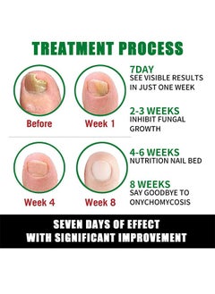 Jaysuing 7 DAYS Nail Fungus Treatment,Ginger Nail Treatment Nail Support Nail Care, , Ginger Nail Growth Serum, Ginger Cuticle Care Oil for Nails 30ml  - Image 3