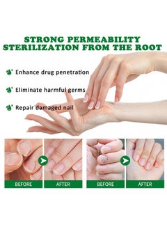 Jaysuing 7 DAYS Nail Fungus Treatment,Ginger Nail Treatment Nail Support Nail Care, , Ginger Nail Growth Serum, Ginger Cuticle Care Oil for Nails 30ml  - Image 2