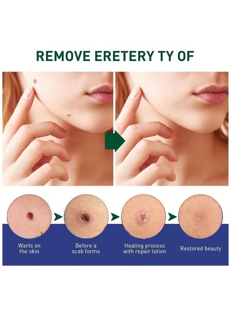 Lanthome Wart Remover, Fast Acting and Painless Skin Tag Remover Liquid, Tags and Mole Remover, Tag-Remover for Hands and Body, Wart Cream for Genital Warts, Plantar Wart, Common Wart, Corn, Flat Wart - Image 2