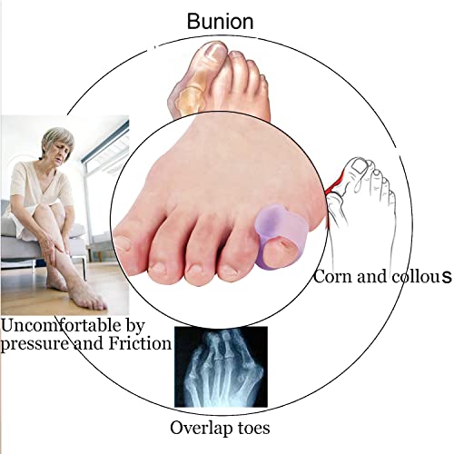 Yimanduo 10 Pcs Pinky Toe Splint, Gel Toe Separators, Little Toe Straightener Hammer Toe for Men Women Walking, Running, Overlapping, Bunion Corrector and Bunion Relief, Small - Image 2