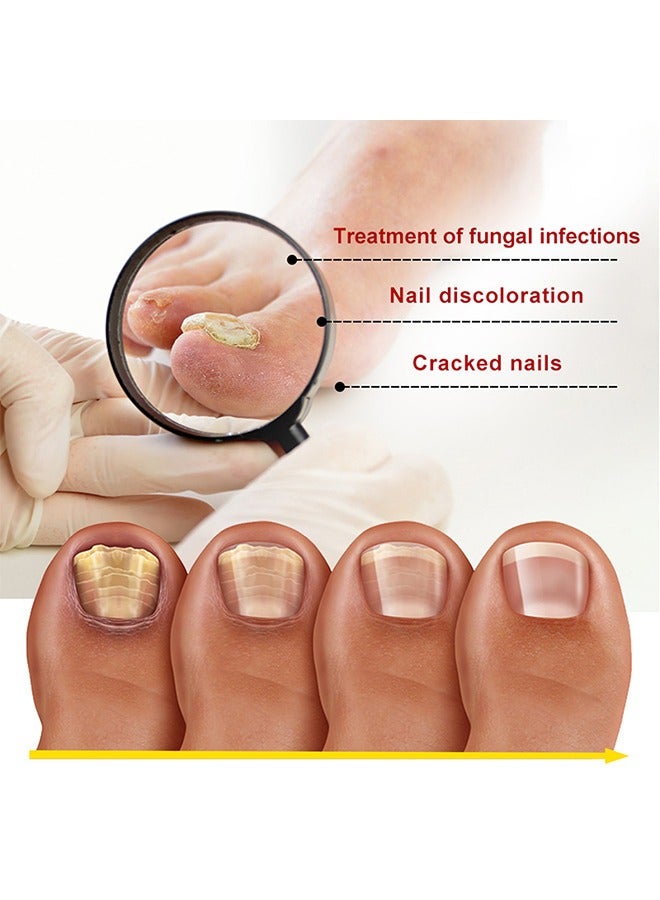 SOUTH MOON Toenail Fungus Treatment Extra Strength-Fungal Nail Treatment for Toe Nail and Fingernails-Nail Repair Solution for Thick/Broken/Discolored Nails-Renews Damaged Cracked Ingrown Toenail - Image 3