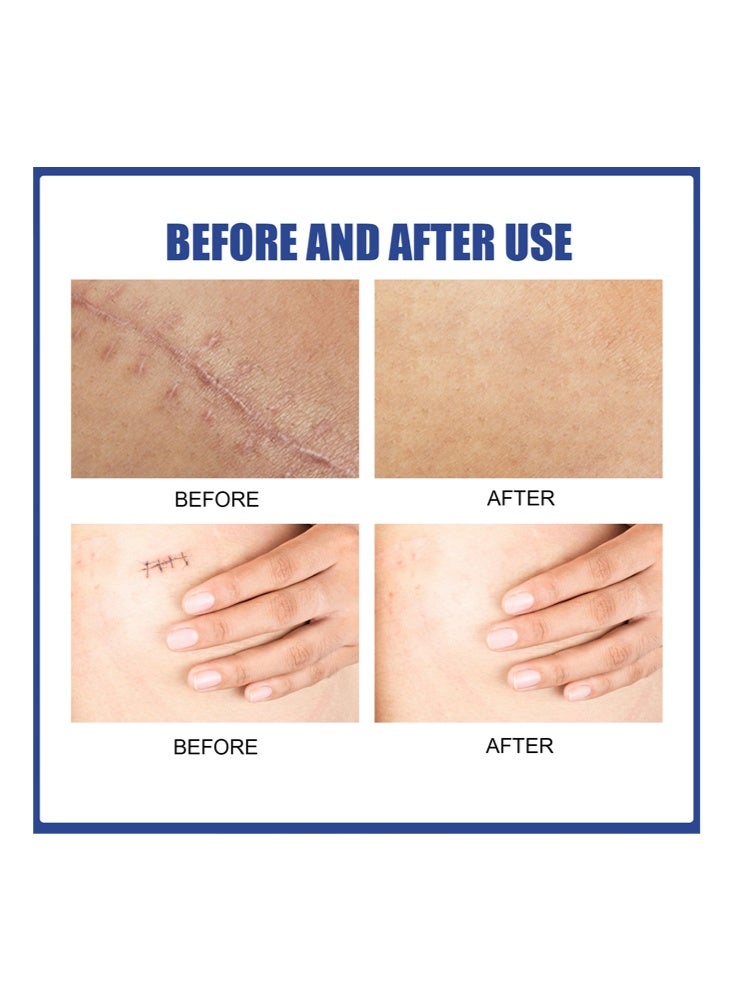 EELHOE Silicone Scar Sheets, Reusable Washable Silicone Scar Tape, Surgery Scars Removal Treatment, Medical Grade Silicone Scar Sheets For You 4-Pairs - Image 5