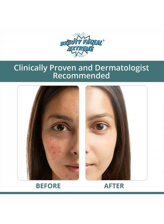 Acne Treatment Clay Mask- Clears Away Clogged Pores, Blackhead & Whitehead Pimples, Blemishes, Scars & Oily Skin for Face & Body. Ingredients Including Sulfur, Bentonite, Kaolin & Jojoba Oil.