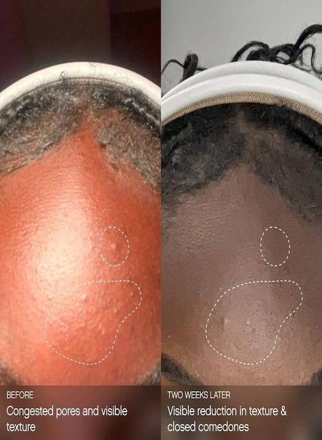 TOPICALS Clearly Acne Clarifying + Calming Mist for Face & Body | Reduces Acne, Blackheads, & Redness | Strengthens Skin Barrier & Evens Texture | 2% Salicylic Acid + AHA | Vegan & Cruelty-Free (4 fl oz) - Image 4