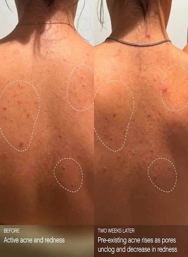 TOPICALS Clearly Acne Clarifying + Calming Mist for Face & Body | Reduces Acne, Blackheads, & Redness | Strengthens Skin Barrier & Evens Texture | 2% Salicylic Acid + AHA | Vegan & Cruelty-Free (4 fl oz) - Image 5