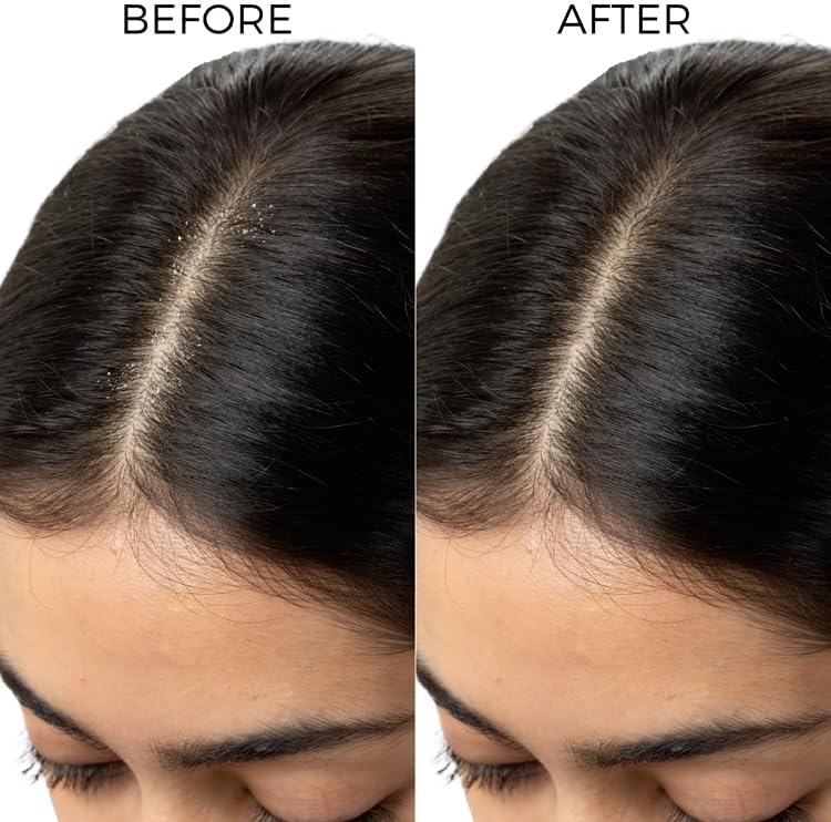 Brillare Anti-Dandruff Shampoo | Lactylate & Salicylic Acid | Reduces Dandruff Flakes in 1 Wash | Soothes Rough, Itchy, Sensitive Scalp | Controls Oil | Promotes Stronger, Healthier Hair (200 ml) - Image 4