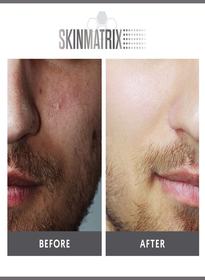 Skinmatrix YISHIQIAnti-Blemish Acne Control Pads- Contains Salicylic, Lactic, & Mandelic Acid. Clears Away Clogged Pores, Whitehead & Blackhead Pimples. Eliminates Acne for Face & Body. - Image 5