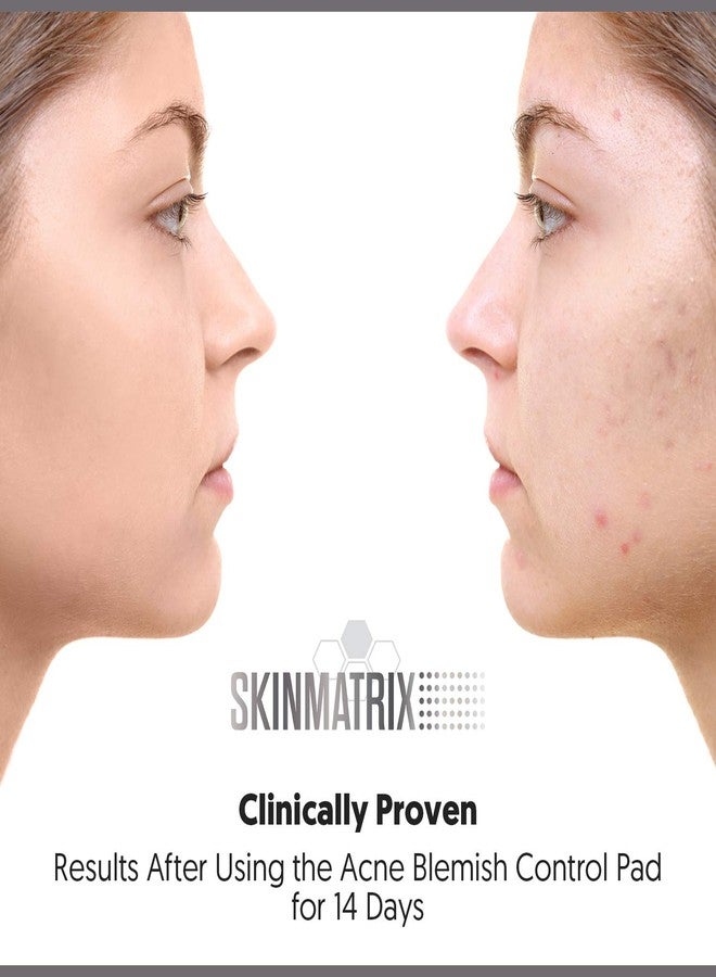 Skinmatrix YISHIQIAnti-Blemish Acne Control Pads- Contains Salicylic, Lactic, & Mandelic Acid. Clears Away Clogged Pores, Whitehead & Blackhead Pimples. Eliminates Acne for Face & Body. - Image 3