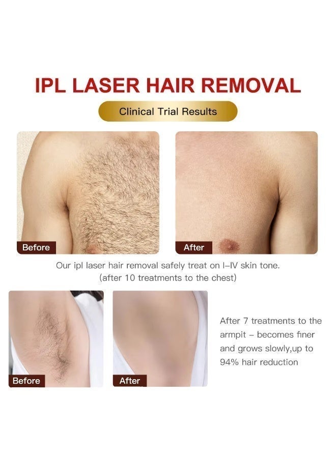 Home Laser Hair Removal Device | Remove Hair, Boost Confidence | Painless With Ice Cooling . For All Skins - Image 4