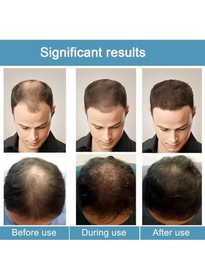 Solution 2-BOX Microneedle Hair, Alphainfuse Hair Regrowth System, Advanced Hair Growth Treatment Serum for Thicker, Fuller Hairs, Strengthens Roots, Gentle Painless, Supports Healthy Hairs Growth for Men & Women (2Pcs) - Image 4