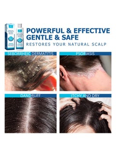 Roycederm Roycederm Psoriasis Shampoo, Seborrheic Dermatitis Shampoo, Folliculitis Shampoo, Dandruff Shampoo, Scalp Psoriasis & Seborrheic Dermatitis Treatment, Dry Itchy Scalp Treatment  - Image 5