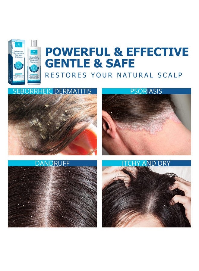 Roycederm Psoriasis Shampoo, Seborrheic Dermatitis Shampoo, Folliculitis Shampoo, Dandruff Shampoo, Scalp Psoriasis & Seborrheic Dermatitis Treatment, Dry Itchy Scalp Treatment