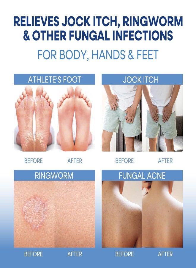 Hermon Antifungal Soap with Tea Tree Oil: Antifungal Bar Soothing Care & Relief of Itchy for Ringworm Jock Itch Athletes Foot - Body & Face Wash (1-Pack (2 Bars Original Tea Tree)) - Image 5