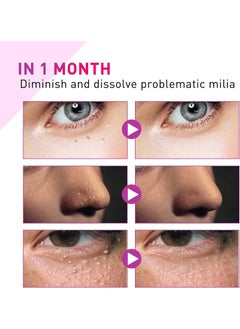 Jaysuing Milia Spot Treatment Helps to Dissolve and Reduce Problematic Remover with Natural Ingredients Gentle on Skin Safe - 30ml  - Image 2